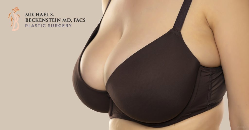 Woman with breast implants. (Model)