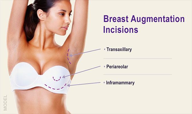 Breast Augmentation Incision locations and types