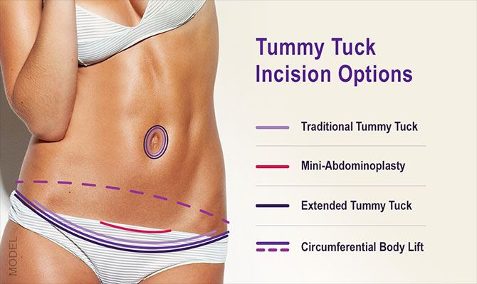 Tummy Tuck for Birmingham & Montgomery, AL