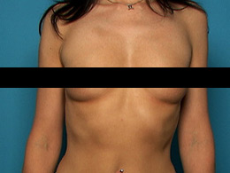 example-frontal-breast-view