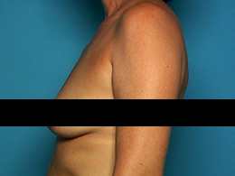 example-side-breast-view