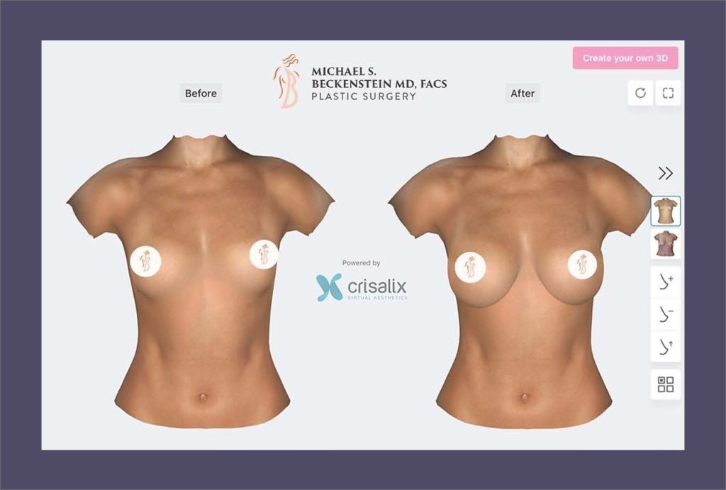 Crisalix Before and After graphic