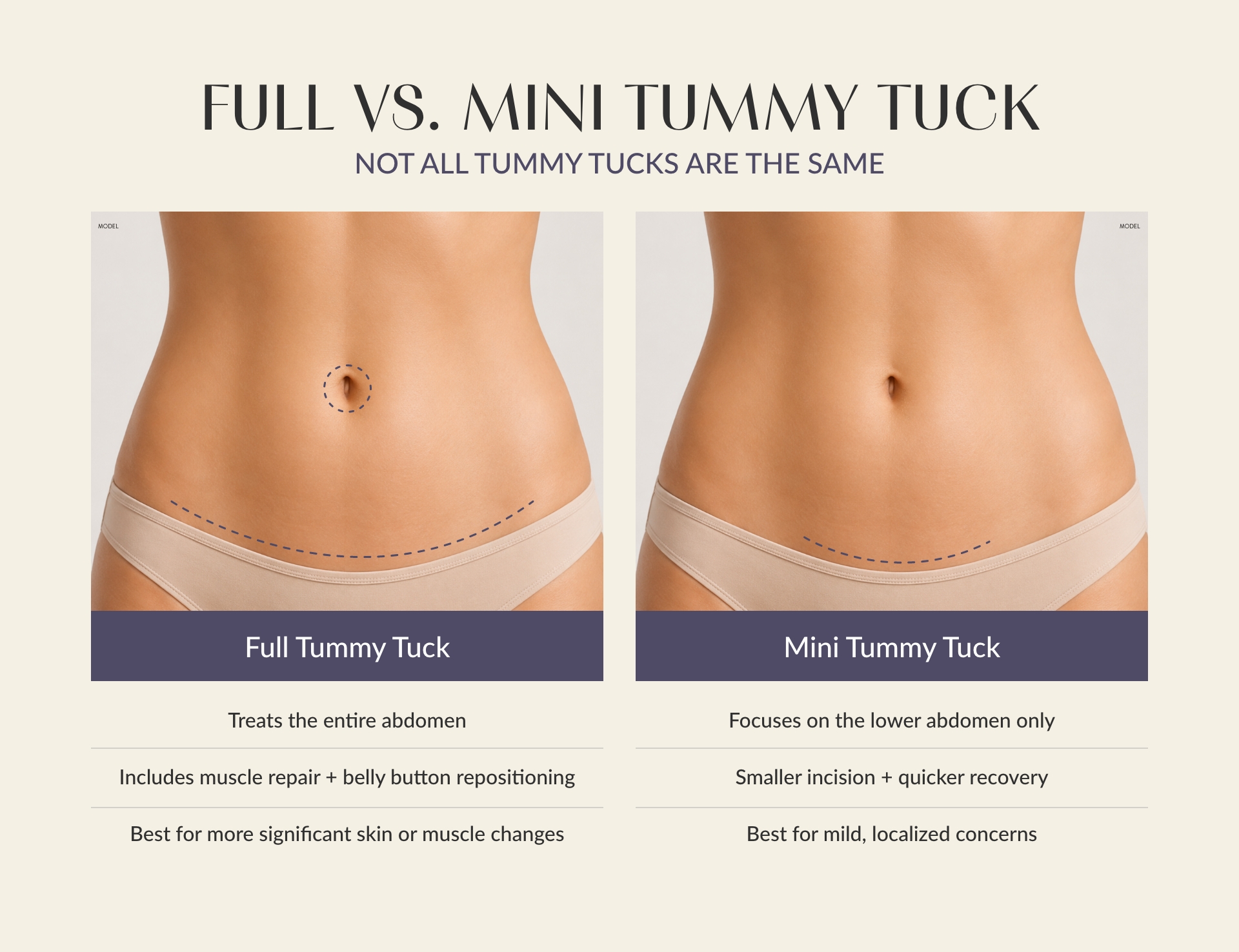 Infographic with 2 female (model) abdomens side by side showing the difference between Full vs Mini Tummy Tuck.