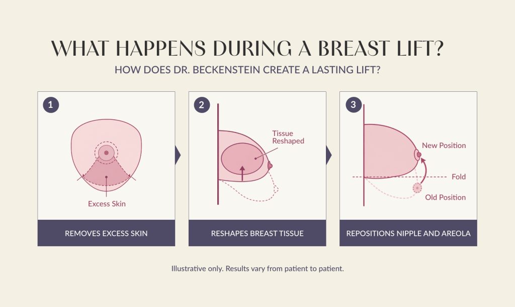 Illustration showing the 3 main steps of a breast lift: excess skin removed, breast tissue reshaped, nipple and areola repositioned.